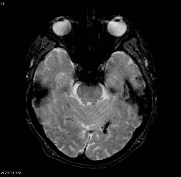 File:Cerebral amyloid angiopathy (Radiopaedia 4567).jpg