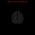 Cerebral and orbital tuberculomas (Radiopaedia 13308-13311 Axial DWI 16).jpg