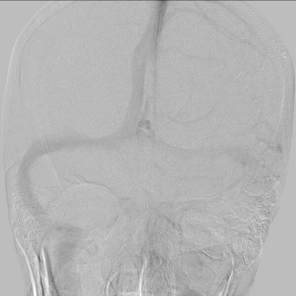 File:Cerebral aneurysm with rupture (Radiopaedia 29933-30458 LT ICA IC 25).jpg