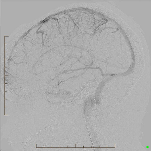File:Cerebral arteriovenous malformation (AVM) (Radiopaedia 78162-90707 B 18).jpg
