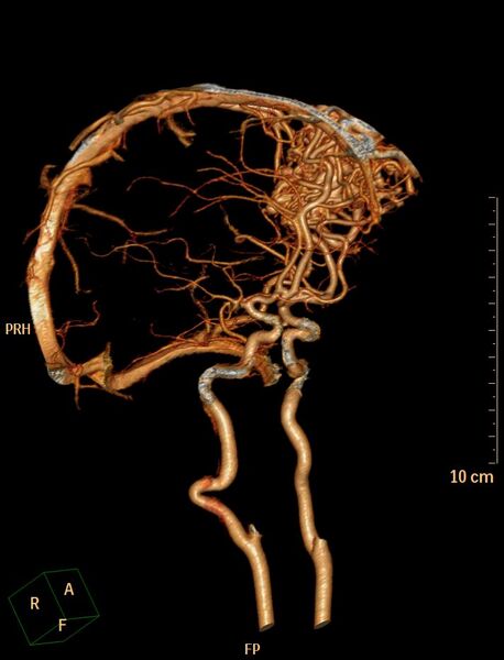 File:Cerebral arteriovenous malformation (Radiopaedia 29531-30031 B 4).jpg
