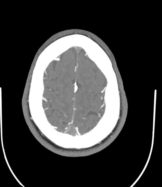 File:Cerebral dural venous sinus thrombosis (Radiopaedia 86514-102576 A 81).jpg