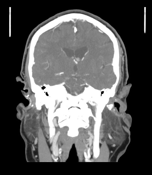 File:Cerebral dural venous sinus thrombosis (Radiopaedia 86514-102576 B 35).jpg
