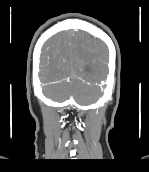 File:Cerebral dural venous sinus thrombosis (Radiopaedia 86514-102576 B 63).jpg