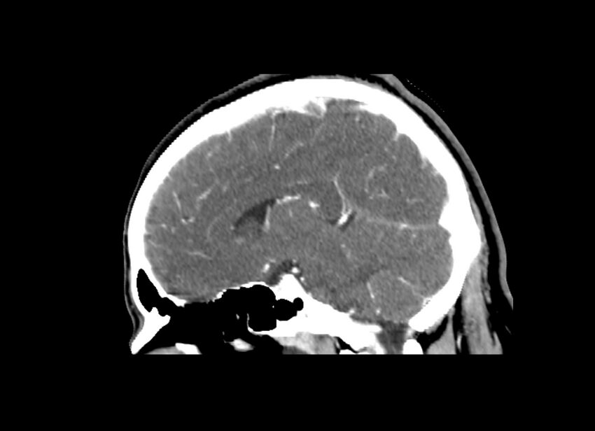 Cerebral edema (Radiopaedia 82519-96661 D 26).jpg