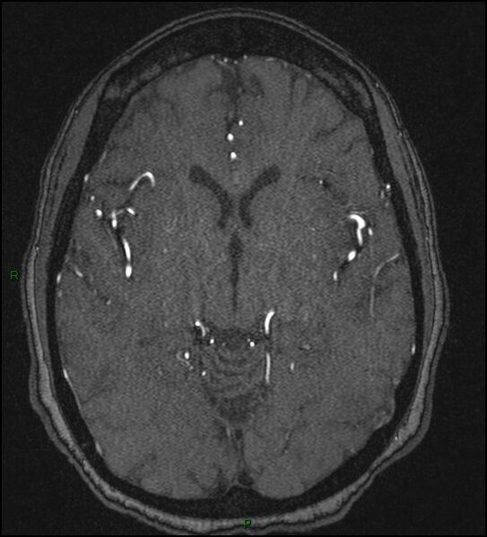 File:Cerebral fat embolism (Radiopaedia 35022-36525 Axial TOF 97).jpg