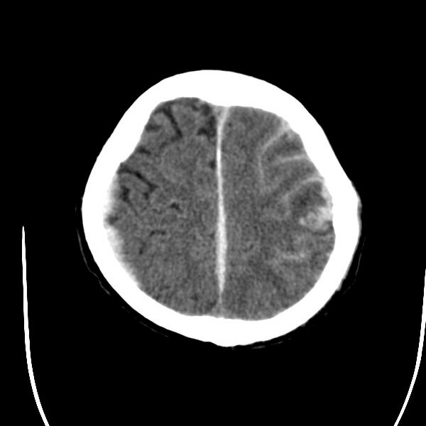 File:Cerebral hemorrhagic contusions (Radiopaedia 23145-23188 Axial non-contrast 33).jpg