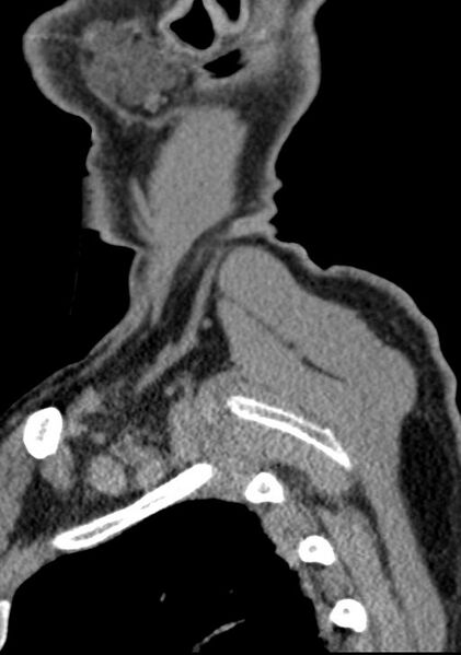 File:Cerebral hemorrhagic contusions and cervical spine fractures (Radiopaedia 32865-33841 G 10).jpg