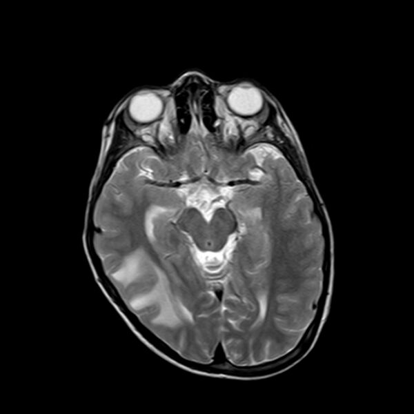 File:Cerebral tuberculoma (Radiopaedia 41152-43932 Axial T2 9).jpg