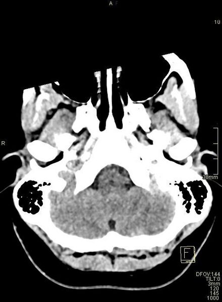 File:Cerebral venous sinus thrombosis (Radiopaedia 91329-108965 Axial non-contrast 8).jpg