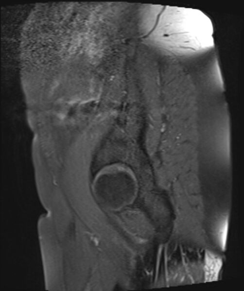 File:Cervical carcinoma (Radiopaedia 88312-104943 Sagittal T1 fat sat 3).jpg