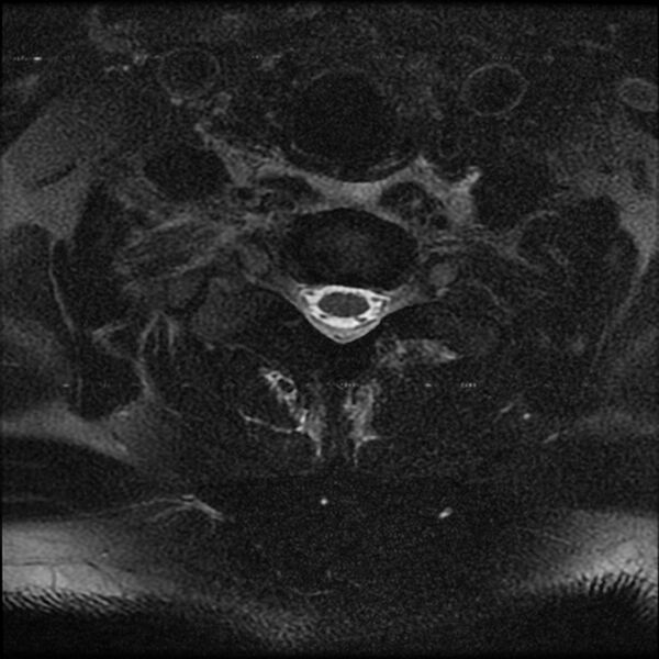 File:Cervical fracture and dislocation with locked facet (Radiopaedia 31837-32781 Axial T2 fat sat 12).jpg