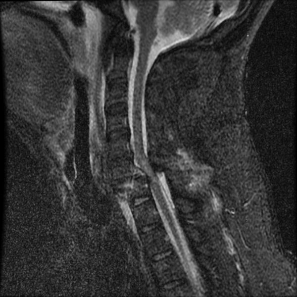 File:Cervical fracture and dislocation with locked facet (Radiopaedia 31837-32781 Sagittal STIR 8).jpg