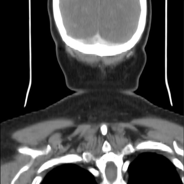 File:Cervical lymphadenopathy. cause unknown (Radiopaedia 22420-22457 None 150).jpg