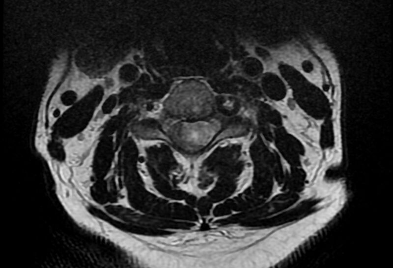 File:Cervical schwannoma (Radiopaedia 72399-82934 Axial T2 8).jpg