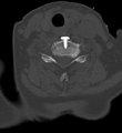 Cervical spine ACDF loosening (Radiopaedia 48998-54070 Axial bone window 41).png