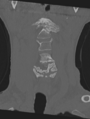 Cervical spondylolysis (Radiopaedia 49616-54811 Coronal bone window 10).png