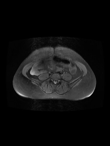 File:Cesarean section scar endometrioma (Radiopaedia 56569-63297 Axial PD fat sat 4).jpg