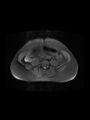 Cesarean section scar endometrioma (Radiopaedia 56569-63297 Axial PD fat sat 4).jpg