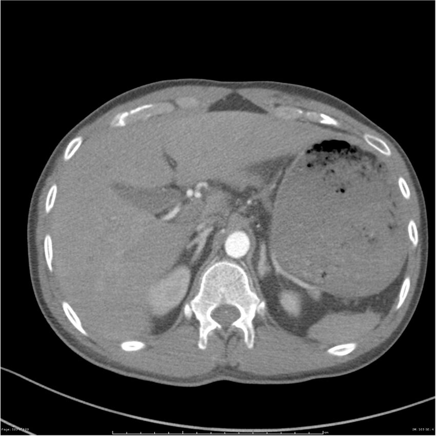 Chest and abdomen multi-trauma (Radiopaedia 26294-26425 A 103).jpg