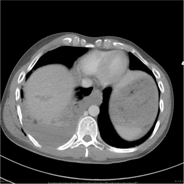 File:Chest and abdomen multi-trauma (Radiopaedia 26294-26426 bone window 11).jpg