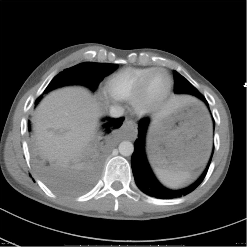 Chest and abdomen multi-trauma (Radiopaedia 26294-26426 bone window 11).jpg