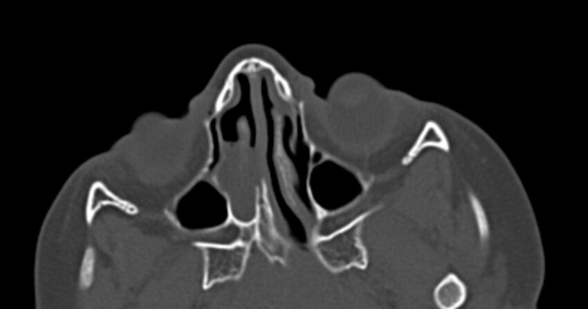 Choanal atresia (Radiopaedia 51295-56972 Axial bone window 31).jpg