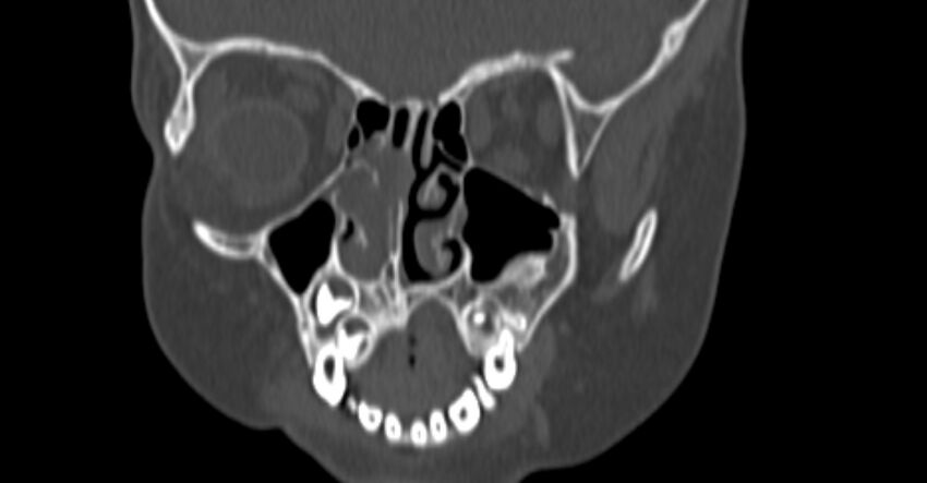 Choanal atresia (Radiopaedia 51295-56972 Coronal bone window 32).jpg