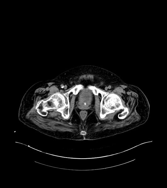 File:Cholangiocarcinoma with cerebral metastases (Radiopaedia 83519-98629 Axial non-contrast 123).jpg
