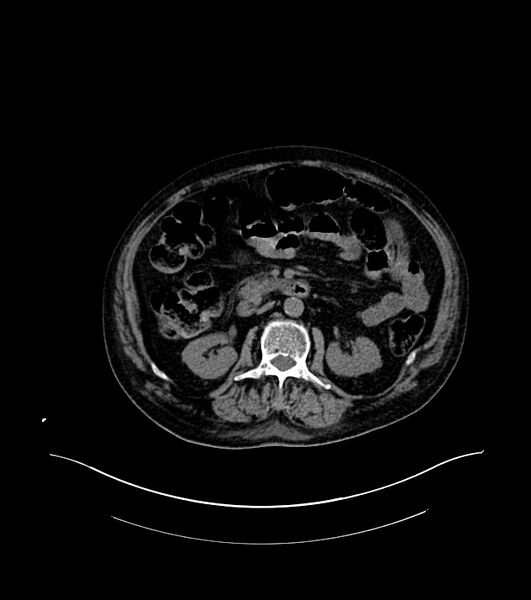 File:Cholangiocarcinoma with cerebral metastases (Radiopaedia 83519-98629 Axial non-contrast 47).jpg
