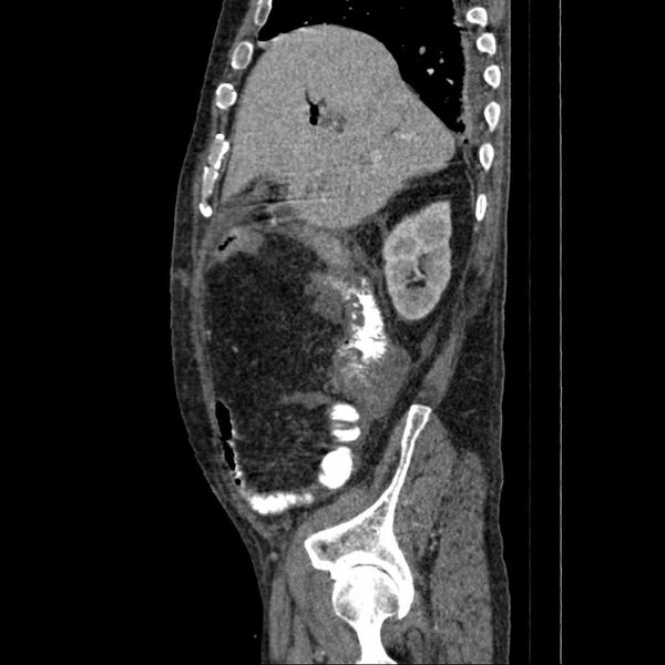 File:Cholangitis and abscess formation in a patient with cholangiocarcinoma (Radiopaedia 21194-21100 B 15).jpg