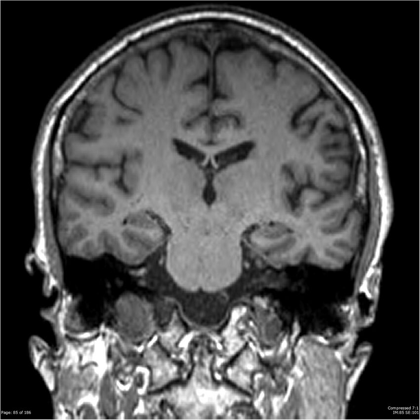 Chondrosarcoma of skull base- grade II (Radiopaedia 40948-43654 Coronal T1 6).jpg
