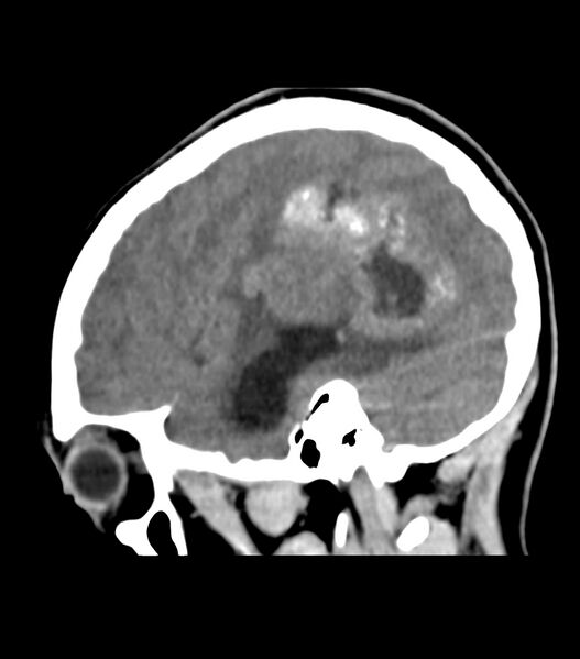 File:Choroid plexus carcinoma (Radiopaedia 91013-108552 B 55).jpg