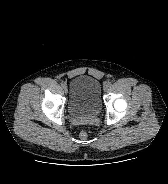 File:Chromophobe renal cell carcinoma (Radiopaedia 84337-99693 Axial non-contrast 148).jpg