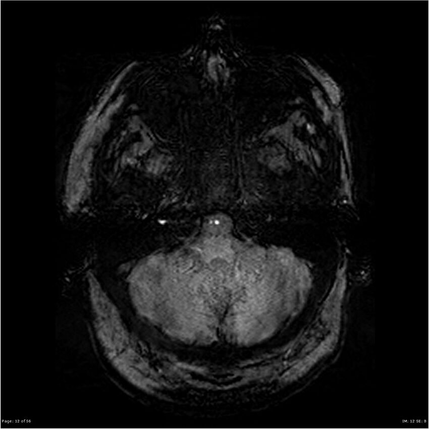 Chronic hypertensive encephalopathy (Radiopaedia 25764-25918 Axial SWI 12).jpg