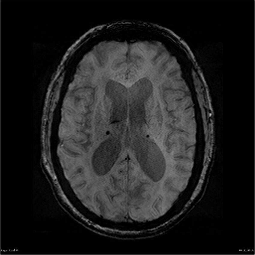 Chronic hypertensive encephalopathy (Radiopaedia 25764-25918 Axial SWI 31).jpg