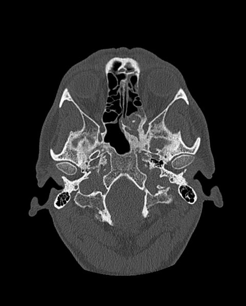 File:Chronic maxillary sinusitis caused by a foreign body (Radiopaedia 58521-65676 Axial bone window 204).jpg