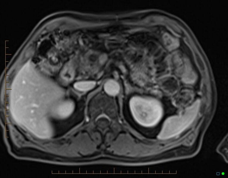 File:Chronic pancreatitis (Radiopaedia 17014-16716 Axial T1 C+ fat sat 28).jpg