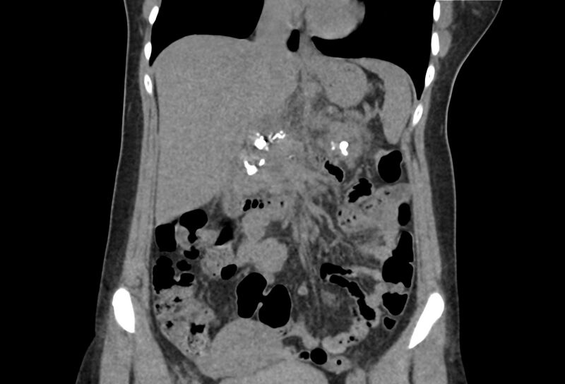 File:Chronic pancreatitis - pancreatic duct calculi (Radiopaedia 71818-82251 Coronal non-contrast 18).jpg