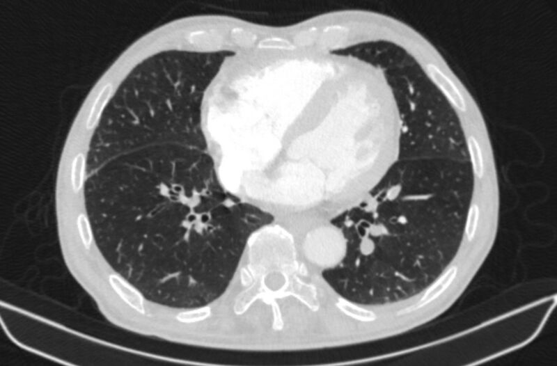 File:Chronic pulmonary embolism (Radiopaedia 91241-108843 Axial lung window 62).jpg