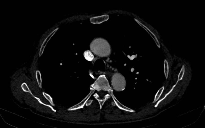 File:Chronic pulmonary embolism (Radiopaedia 91241-108843 B 64).jpg