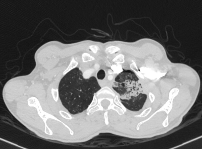 File:Chronic pulmonary embolism with bubbly consolidation (Radiopaedia 91248-108850 Axial lung window 16).jpg