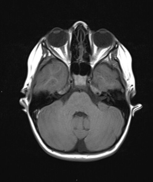 File:Chronic reactive multifocal osteomyelitis (CRMO) - mandible (Radiopaedia 56405-63069 Axial T1 24).jpg