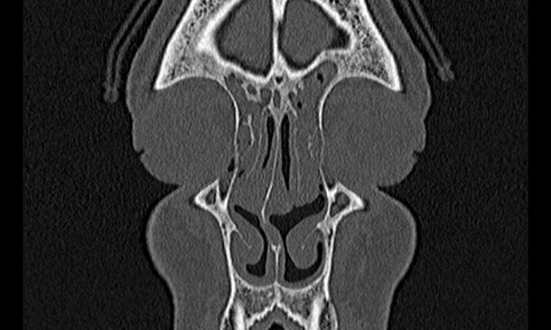 File:Chronic rhinosinusitis (Radiopaedia 65079-74075 Coronal bone window 13).jpg