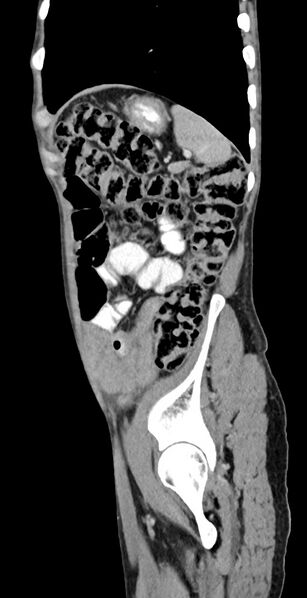 File:Chronic small bowel volvulus (Radiopaedia 75224-86322 C 34).jpg