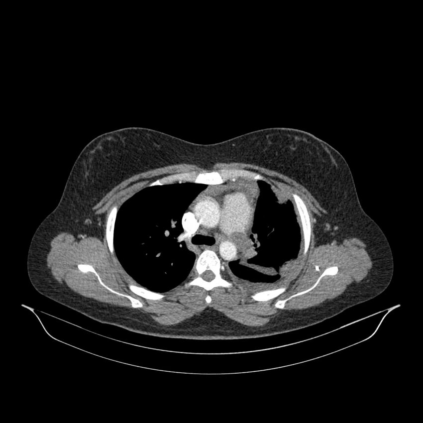 Chronic thromboembolic pulmonary hypertension (CTEPH) (Radiopaedia 74597-85532 Axial C+ CTPA 107).jpg