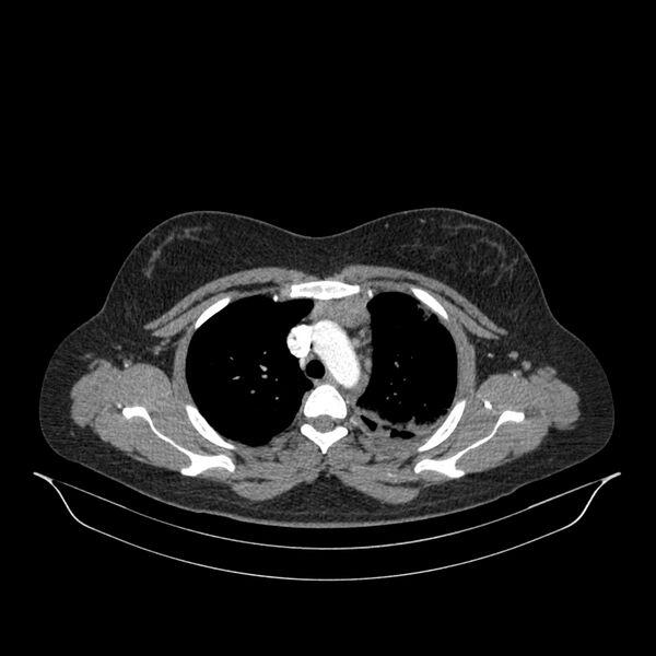 File:Chronic thromboembolic pulmonary hypertension (CTEPH) (Radiopaedia 74597-85532 Axial C+ CTPA 118).jpg