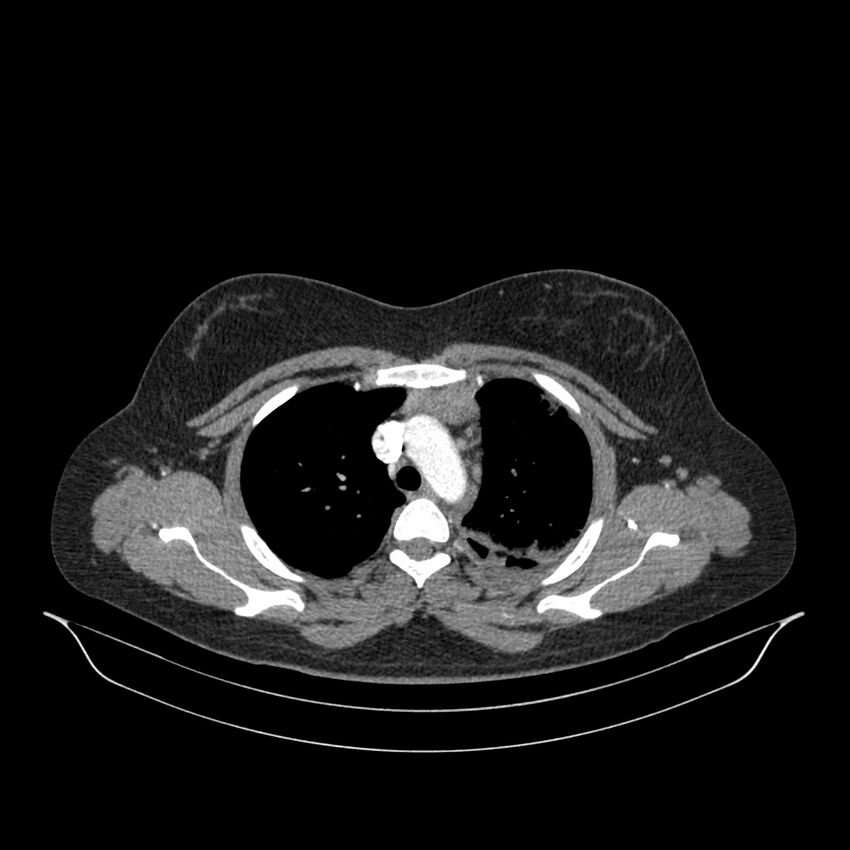 Chronic thromboembolic pulmonary hypertension (CTEPH) (Radiopaedia 74597-85532 Axial C+ CTPA 118).jpg
