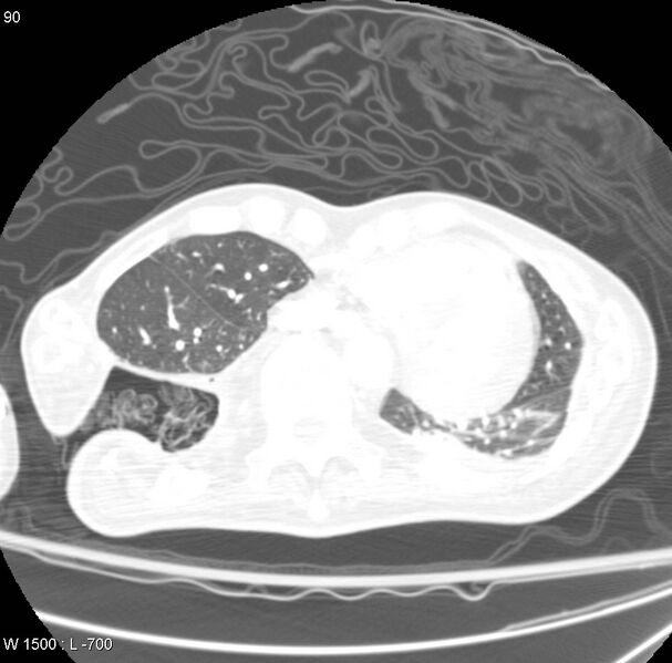 File:Clagett thoracotomy (Radiopaedia 8568-9403 Axial lung window 7).jpg
