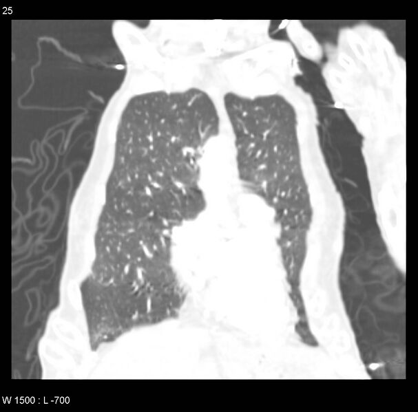 File:Clagett thoracotomy (Radiopaedia 8568-9403 Coronal lung window 25).jpg